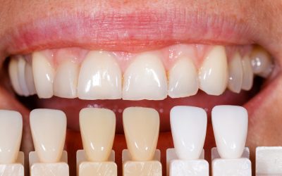 What Invisalign in Redding is and Its Benefits